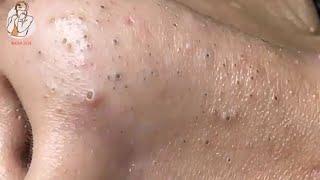 Satisfying Blackhead Video  Video Komedo Memuaskan #102