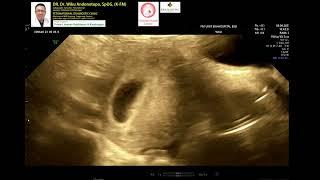 Kehamilan 8 minggu USG Abdomen