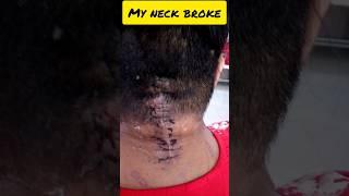 My Road Accident To Recovery #shorts #shortsvideo #youtubeshorts