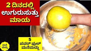 ಎರಡೇ ದಿನದಲ್ಲಿ ಉಗುರುಸುತ್ತು ಮಾಯ  Uguru Suttu Home Remedies  Fungal Infection in Nails #UguruSuttu