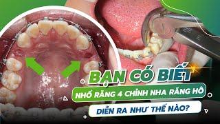 Nhổ răng Hàm Nhỏ Niềng Răng Giảm Hô Như Thế Nào?