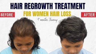 PRP Hair Loss Treatment For Females Before & After Results at CARA 