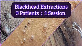 Blackhead extractions in 3 Patients in a single day  @Dr.AMAZINGSKIN
