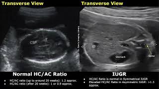 Obstetric Ultrasound Normal Vs Intrauterine Growth Restriction IUGR  Placental Insufficiency USG