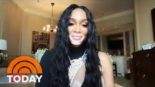 Supermodel Winnie Harlow Talks Embracing Vitiligo New Company