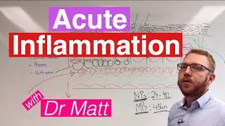 Acute Inflammation  Immunology