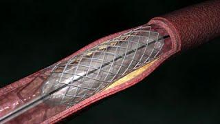 Coronary Artery Angioplasty  Radial Access