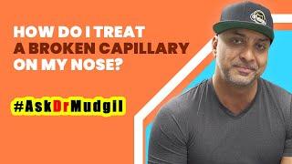 HOW DO I TREAT A BROKEN CAPILLARY ON MY NOSE?