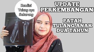 #DYSTORYTIME  CERITA PERKEMBANGAN PATAH TULANG PADA ANAK  UPDATEAN TERAKHIR