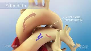 Patent Ductus Arteriosus PDA Occlusion Procedure