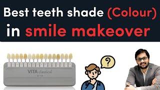 Best teeth colour in smile design  Smile design in 1 day in Indore