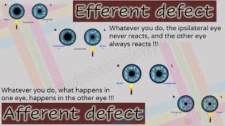 Pupil 2  Characteristics of Afferent and Efferent Pupillary Defects