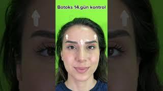 Botoks 14. gün kontrol  #shorts #shortvideo #short #estetik #short #botoks #botox #shortsvideo