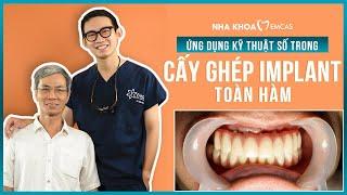 Quy trình cấy ghép implant toàn hàm tại Nha khoa EMCAS