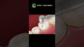 Dental Caries Damages Tooth AMAZING Dental ASMR Animation  Mengs Stop Motion