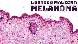 Lentigo maligna melanoma from chronic UV exposure sun damage pathology dermpath dermatology