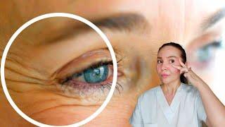 How to reduce under eye wrinkles  Wrinkles around the eyes Crowsfeet