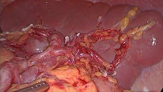 Laparoscopic Spleen-Preserving No. 10 Lymph Node LN Dissection