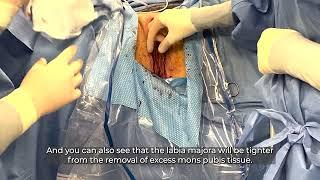 ALVR Procedures Monsplasty and Labia Majora Reduction Surgery