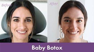 Baby Botox Experience  Getting Botox for the First Time