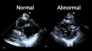 Echocardiogram from the Patient Compared with That from a Normal Control  NEJM