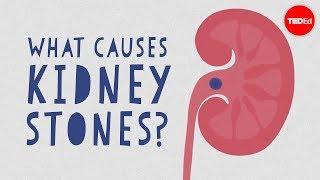 What causes kidney stones? - Arash Shadman