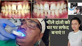 पीले दांतो को घर पर सफेद  बनाएं  agaro dazzle instant teeth whitening