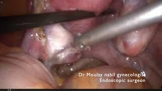 Bilateral salpingectomy before IVF procedure