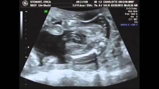 Live Ultrasound at 18 weeks 3 days pregnant with baby number two.