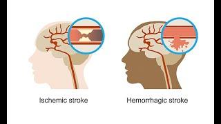 Recognizing hemorrhagic strokes–Neurology Masterclass