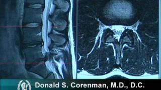 How to Read a MRI of a Lumbar Herniated Disc  Lower Back Pain  Colorado Spine Surgeon