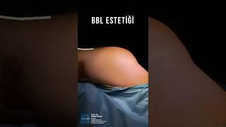 BBL ESTETİĞİ -POPO KALDIRMA AMELİYATI