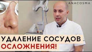  УДАЛЕНИЕ СОСУДОВ ЛАЗЕРОМ  ОСЛОЖНЕНИЯ