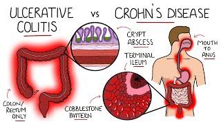Inflammatory Bowel Disease - Ulcerative Colitis v Crohns Disease With Histology & Manifestations