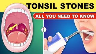 Tonsil Stones  Tonsil Stones Treatment  Tonsil Stone Removal - All You Need to Know
