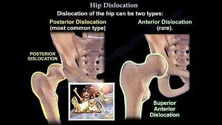 Dislocation of the hip  - Everything You Need To Know - Dr. Nabil Ebraheim