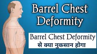 Barrel Chest  Chest Deformity Simplified  Barrel Chest Breathing