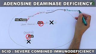 Adenosine Deaminase Deficiency  SCID