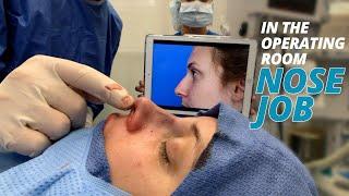 Nose Job Surgery Footage IN THE OPERATING ROOM