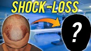 IL PRIMO MESE DOPO IL TRAPIANTO DI CAPELLI - SHOCK LOSS