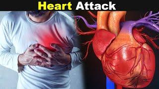 Heart Attack Mayocardial Infarction  SymptomsCauses And Treatments UrduHindi