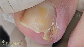  UNHA ENCRAVADA LATERAL COM GRANULOMA SUBUNGUEAL ESTÁGIO IV #satisfying