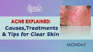 Acne Explained Causes Treatment & Tips for Clear Skin  Health Matters  July 15 2024