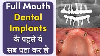 Full Mouth फिक्स बत्तीसी के पहले आपको ये जानना जरूरी  fix Teeth in Indore  Dr. Ankit  Seraphic