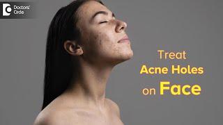 Top Ways to Get Rid of ACNE HOLES  How to fill ACNE HOLES on face?-Dr. Rasya Dixit Doctors Circle