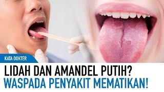 Lidah dan Tenggorokan Putih? Awas Kenali Penyakit Mematikan Ini  Kata Dokter