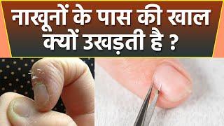 नाखूनों के पास की खाल उखड़ने का कारण  Nakhun ke pass ki skin fatna kesa hai  Boldsky *health