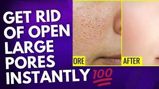 How to Treat OPEN PORES ENLARGED Pores Causes and Treatment  Natural Remedy at Home