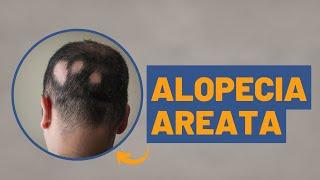 Alopecia Areata o que é como tratar e mais  Dra. Débora Cadore  Dermatologista em Florianópolis