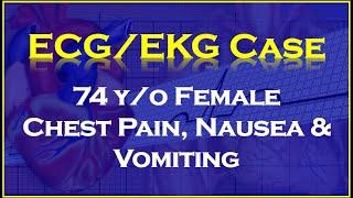 ECGEKG Case Review 74 yo female that had been having chest pain nausea and vomiting.